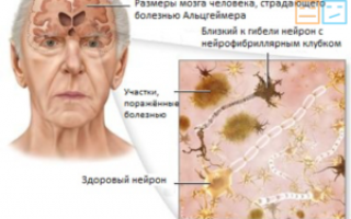 Симптомы и общие принципы медикаментозной терапии болезни Альцгеймера