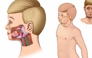 Паротит (свинка) у детей