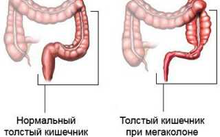 Мегаколон кишечника: виды, причины и лечение