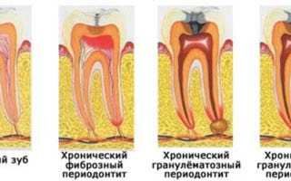 Классификация периодонтитов