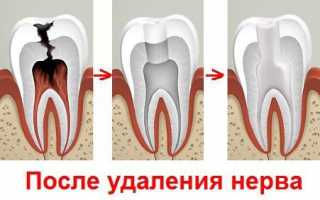 Удаление зубного нерва