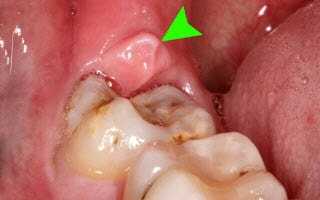 Осложнения после удаления зуба мудрости