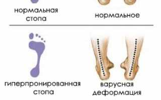 Как не допустить развития плоскостопия у детей