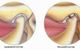 Артрит челюстного сустава