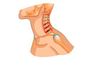 Прогрессирование шейного остеохондроза на фоне дистонии