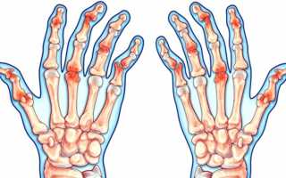 Диагностика и лечение псориатического артрита с прогнозами от врачей
